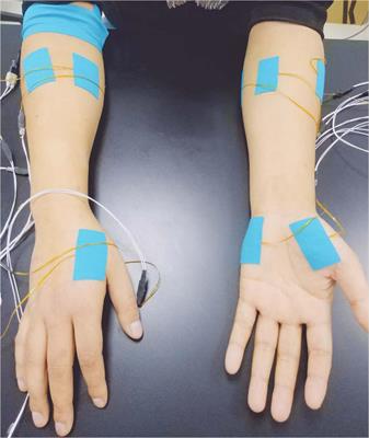 Quantitative Assessment of Traumatic Upper-Limb Peripheral Nerve Injuries Using Surface Electromyography